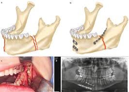 Advanced OPG Scan - Detect Dental Issues Efficiently